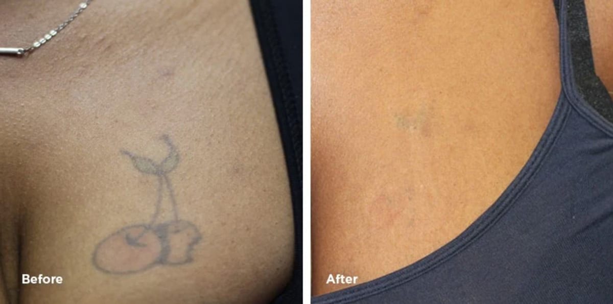 Chest Tattoo Removal Results | Case Study | Removery 595_x_1200_jpg