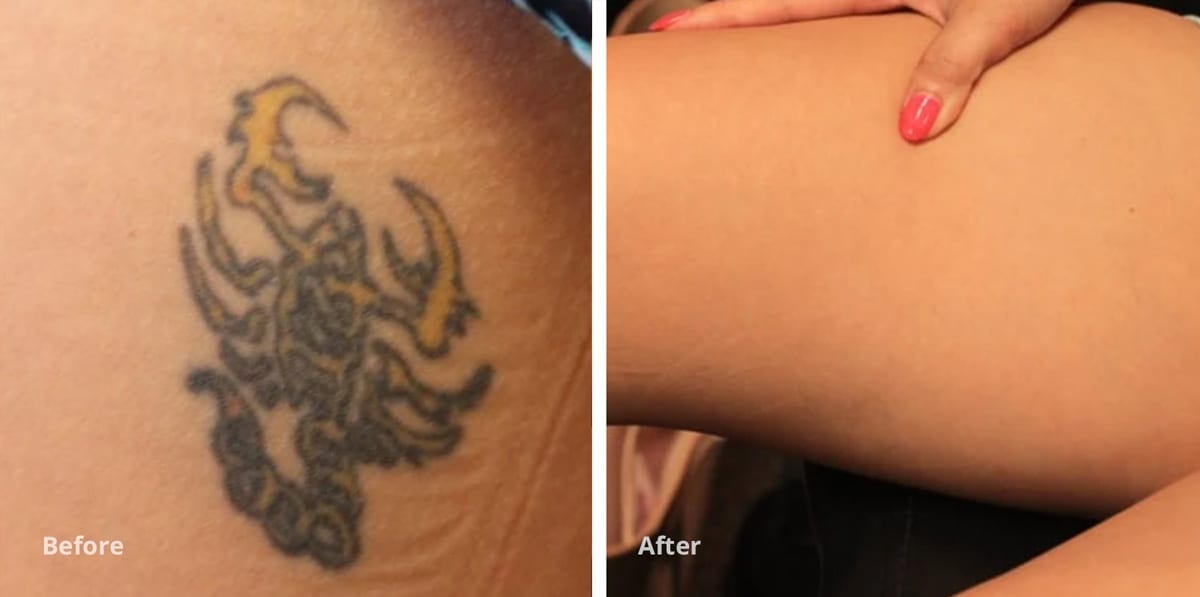 Is Tattoo Removal Safe | Removery 597_x_1200_jpg
