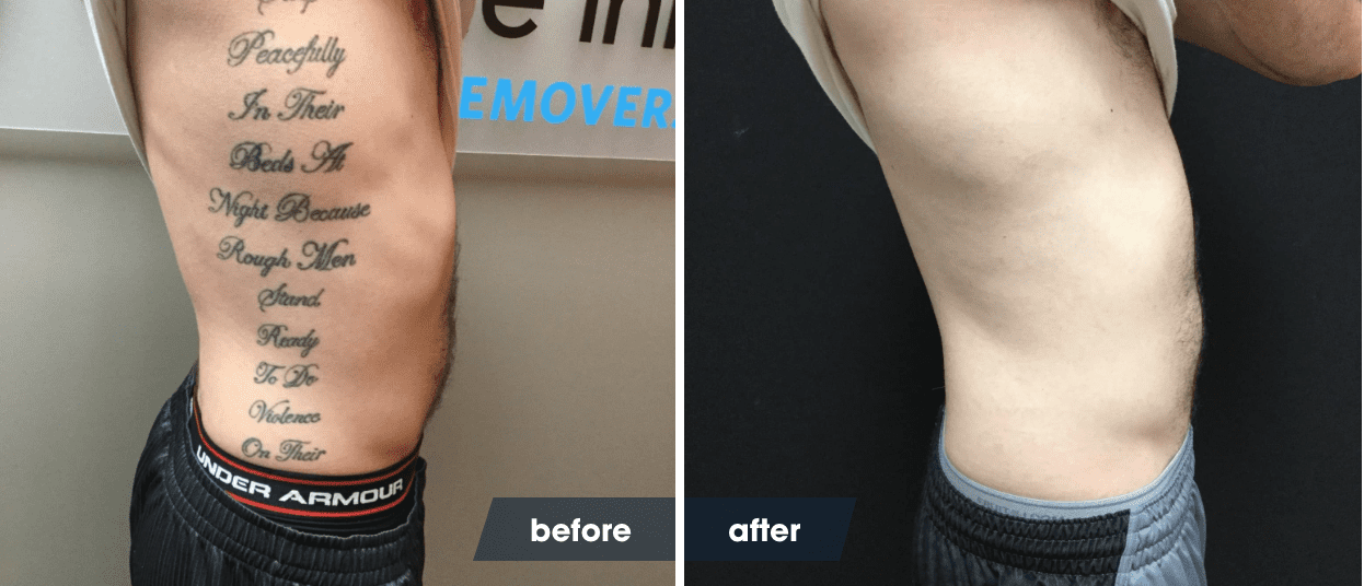 The Laser Tattoo Removal Healing Process | Removery 536_x_1246_png