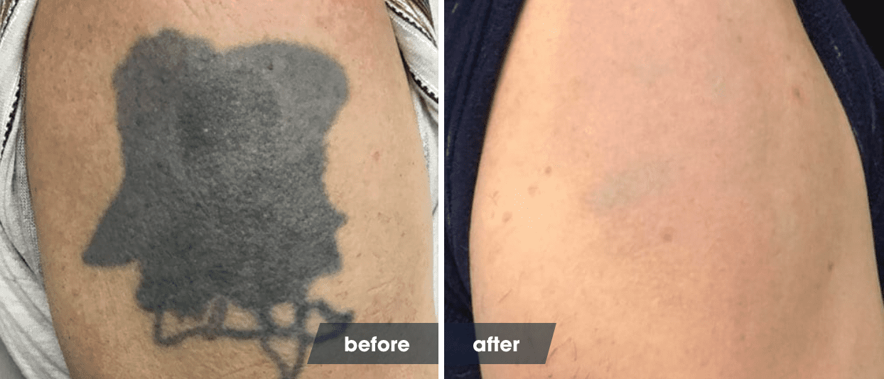 The Laser Tattoo Removal Healing Process | Removery 534_x_1244_png