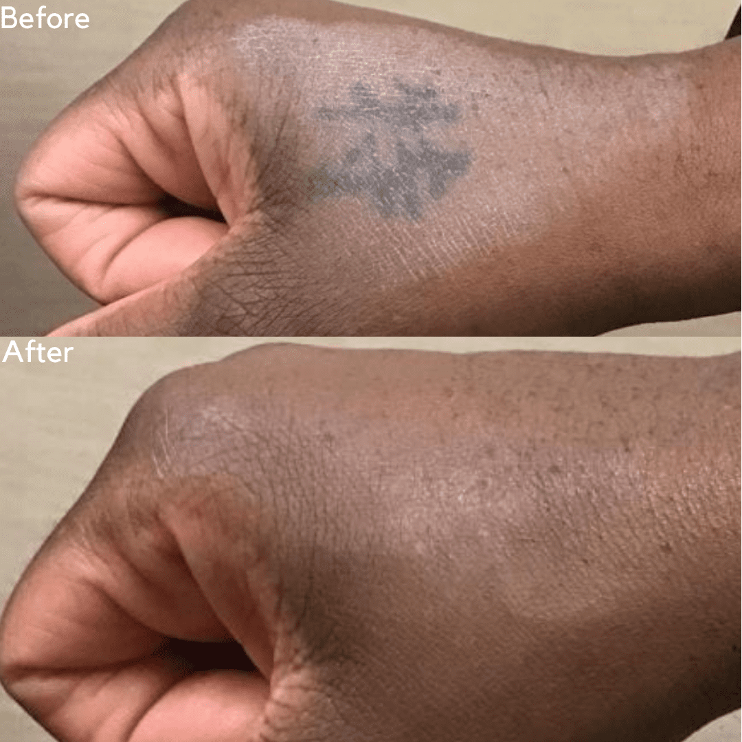 Tattoo Removal Archives | Page 3 Of 9 | Removery 1080_x_1080_png