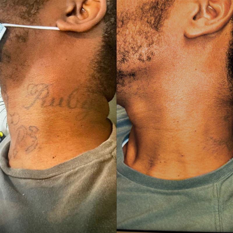 Vol 2: Top 6 Tattoo Removals On Dark Skin Types | Removery 800_x_800_jpg