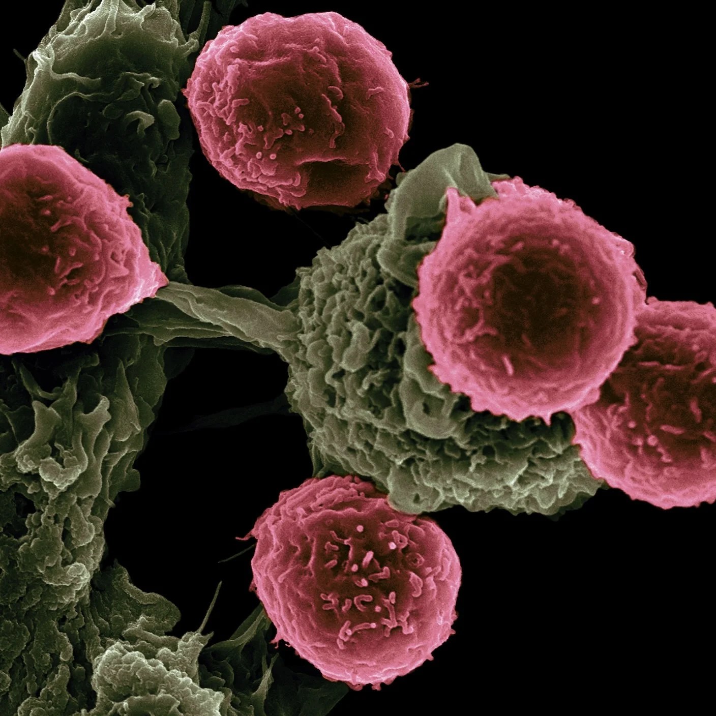 CAR T Therapy Wipes Out Deadly Metastasized Cancer in Mice CAR T Therapy Wipes Out Deadly Metastasized Cancer in Mice