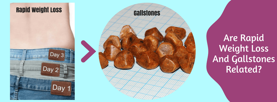 Gallstone