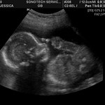 22 Week Ultrasound