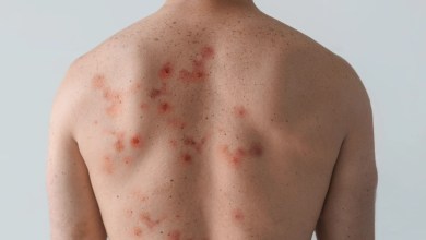 Mpox warning issued in UK after cases spread in Europe