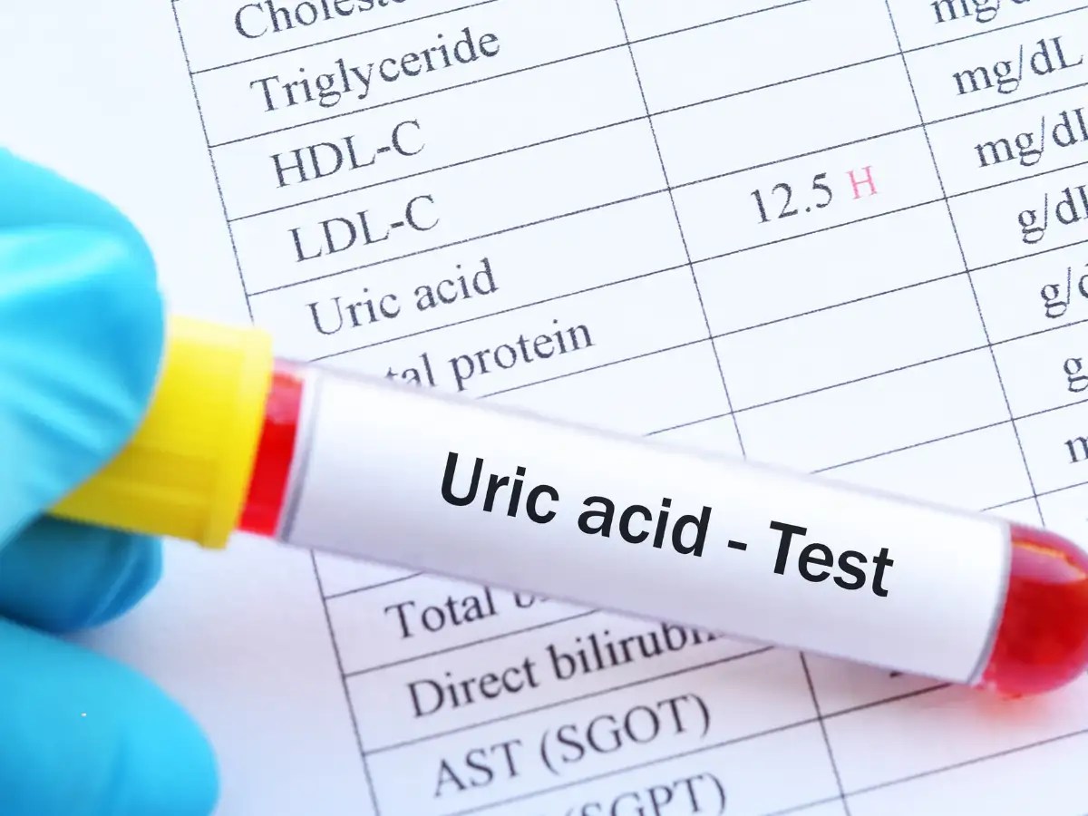 Uric Acid Level Reduction Natural Remedies: 5 effective remedies to reduce uric acid levels