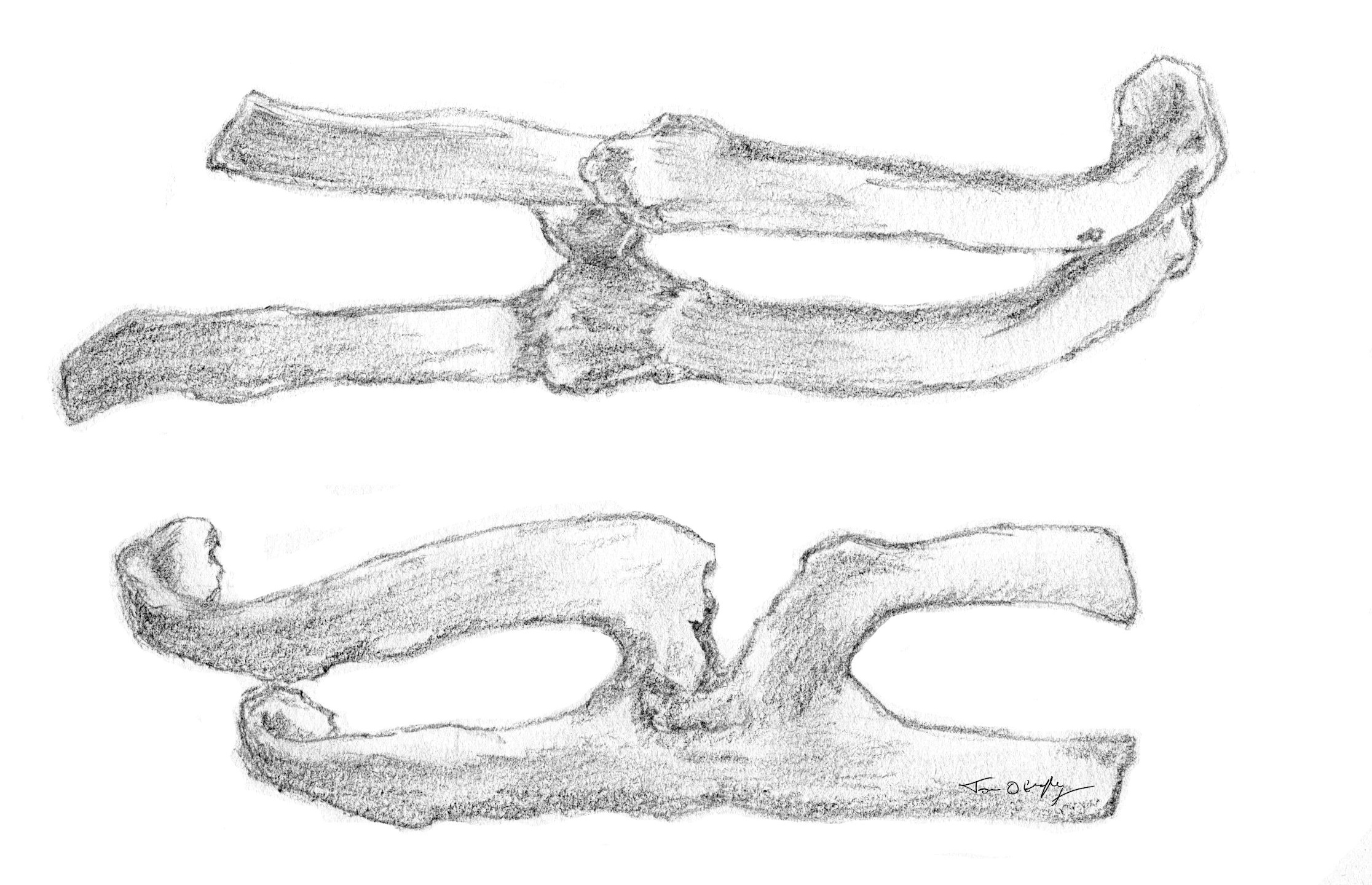Fracture de côtes | thoracotomie