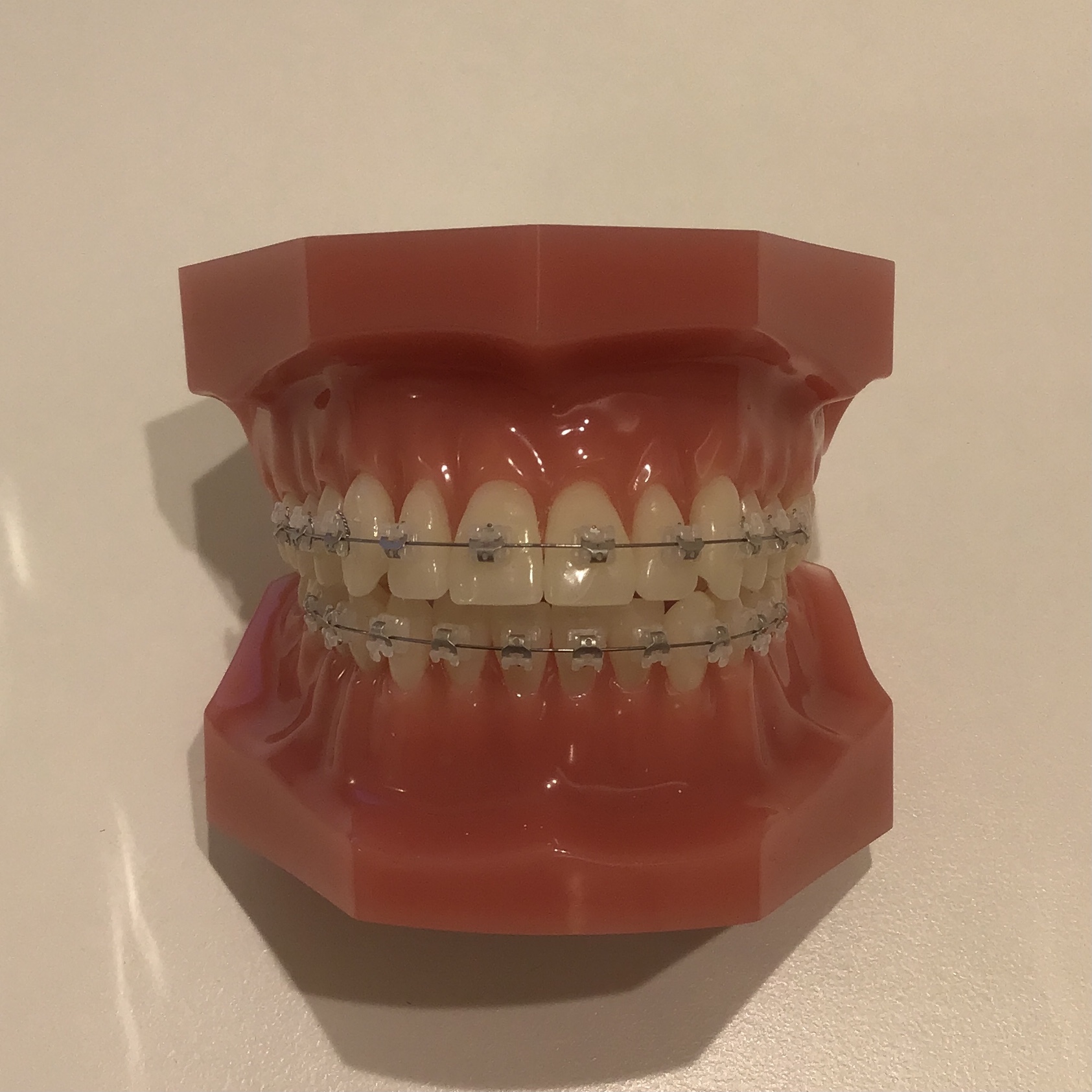 受け口は矯正して治した方がいいの？ - 【公式】梅田キュア矯正歯科 | 大阪梅田の目立たない歯列矯正