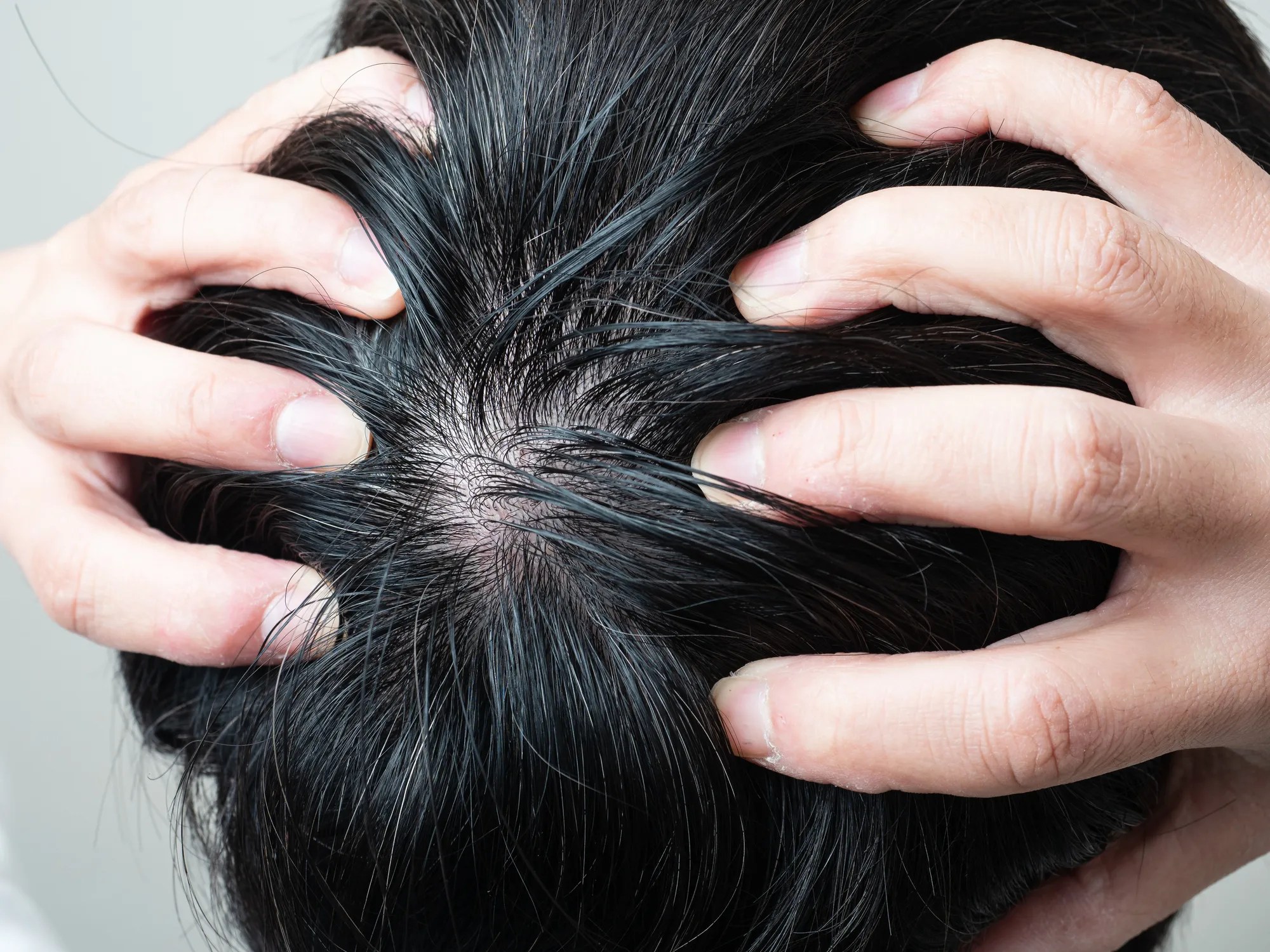 つむじはげ・てっぺんはげの原因と治し方とは？判断基準やセルフチェック方法も解説！ | 【公式】ウィルAGAクリニック