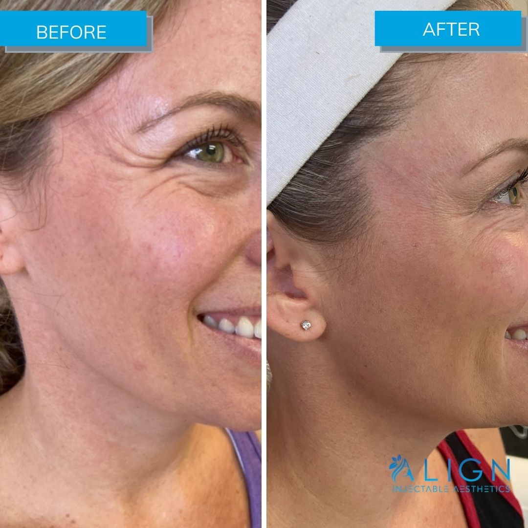 List 32+ Background Images botox crows feet before and after photos Sharp