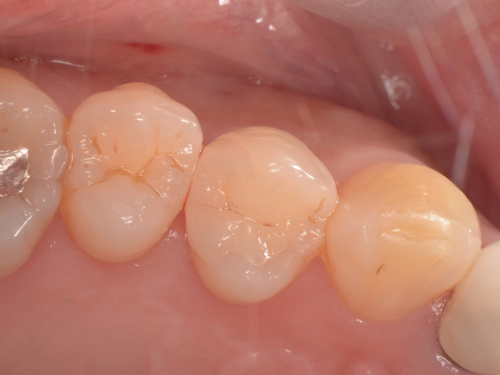 虫歯治療 アーカイブ - 5ページ目 (6ページ中) - アズ歯科 桶川院