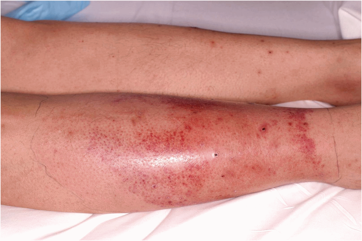 L’erysipèle : Tout savoir de cette infection cutanée