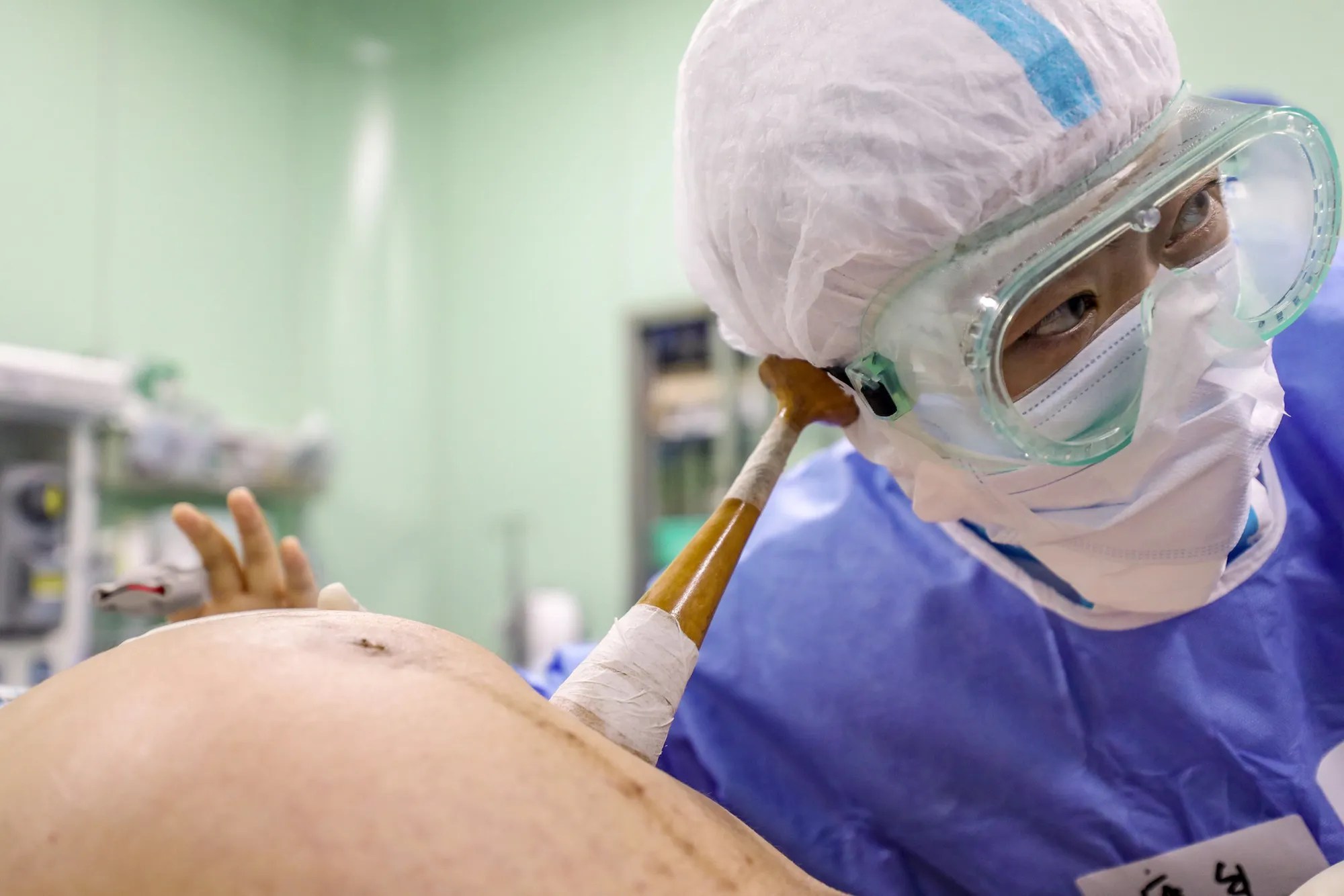 COVID pregnancies may have boosted autism risk