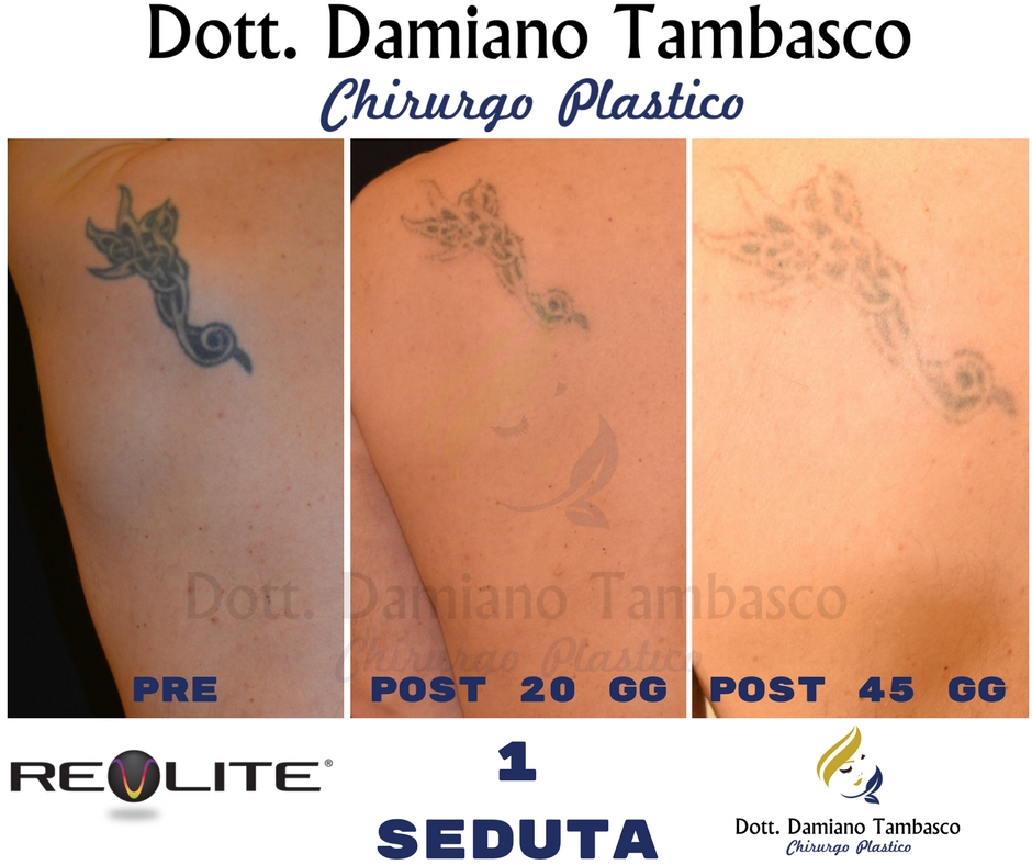 Rimozione Tatuaggi Roma - Liposuzione Roma 788_x_940_jpg