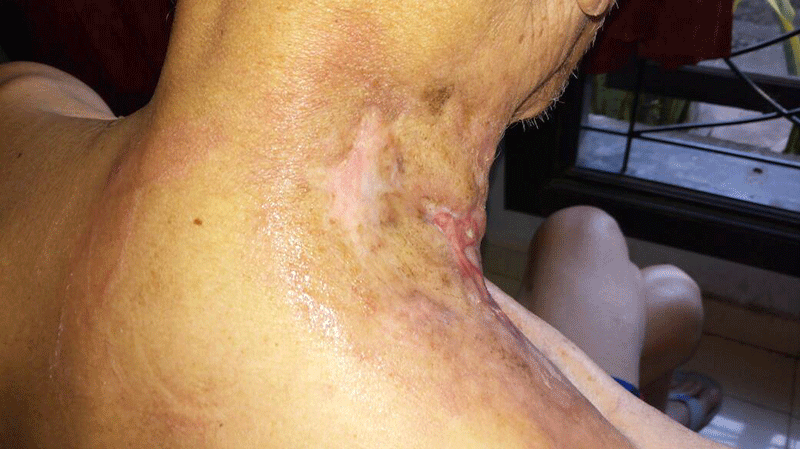 Sarang Semut Papua Tumpas Kanker, Tumor, Kista, dan Benjolan Mulai 30  Hari?! • Deherba.com