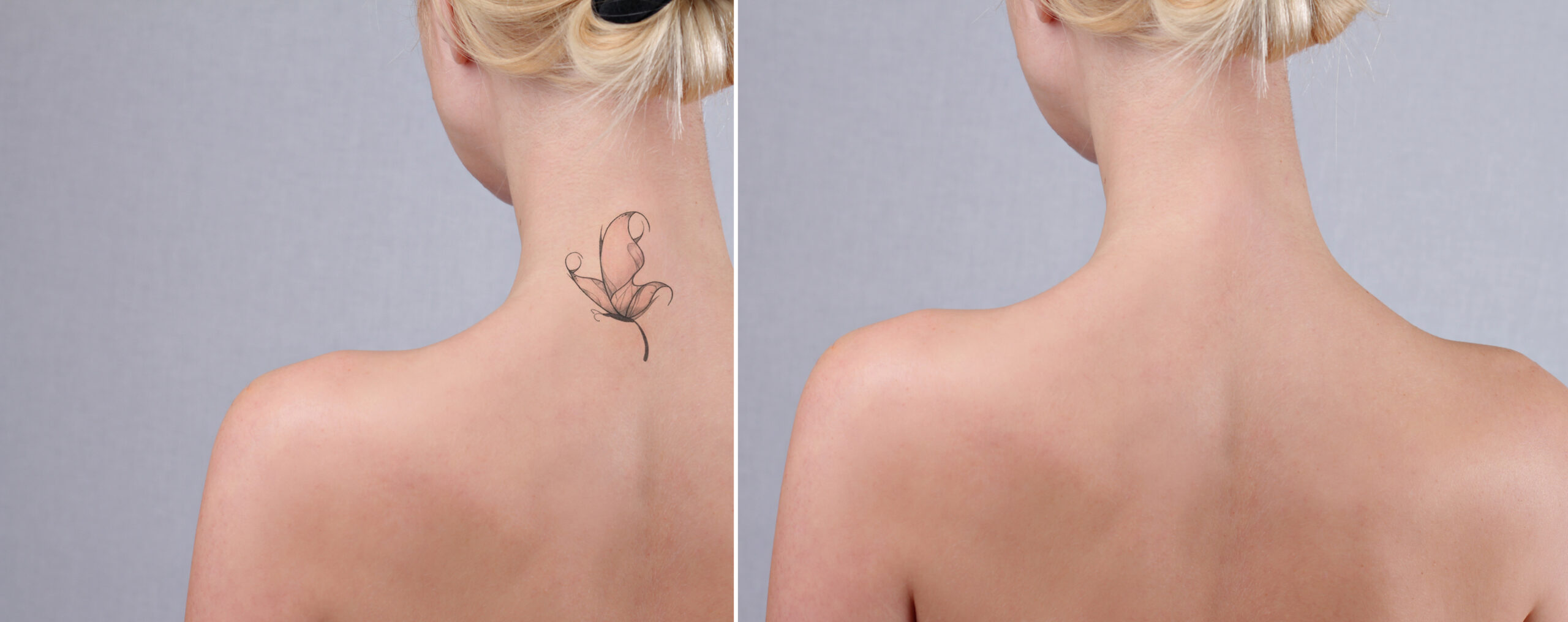 Rimozione Tatuaggio, Quante Sedute? - Dr. Zanframundo Dermatologo Bari 1016_x_2560_jpg