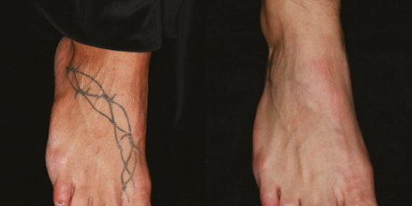 Rimozione Tatuaggi - Dr. Zanframundo - Dermatologo Bari 231_x_462_jpg