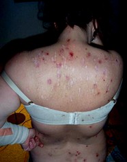 Morgellos Il Morbo Che Viene Dal Futuro