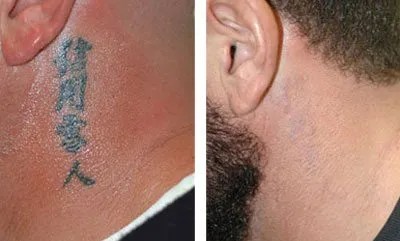 Will My Tattoo Be Completely Gone After Laser Treatments? - Inkfree, Md 241_x_400_jpg