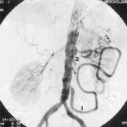 John Libbey Eurotext Hepato Gastro Oncologie Digestive Ischemie Intestinale Chronique Diagnostic Et Traitement
