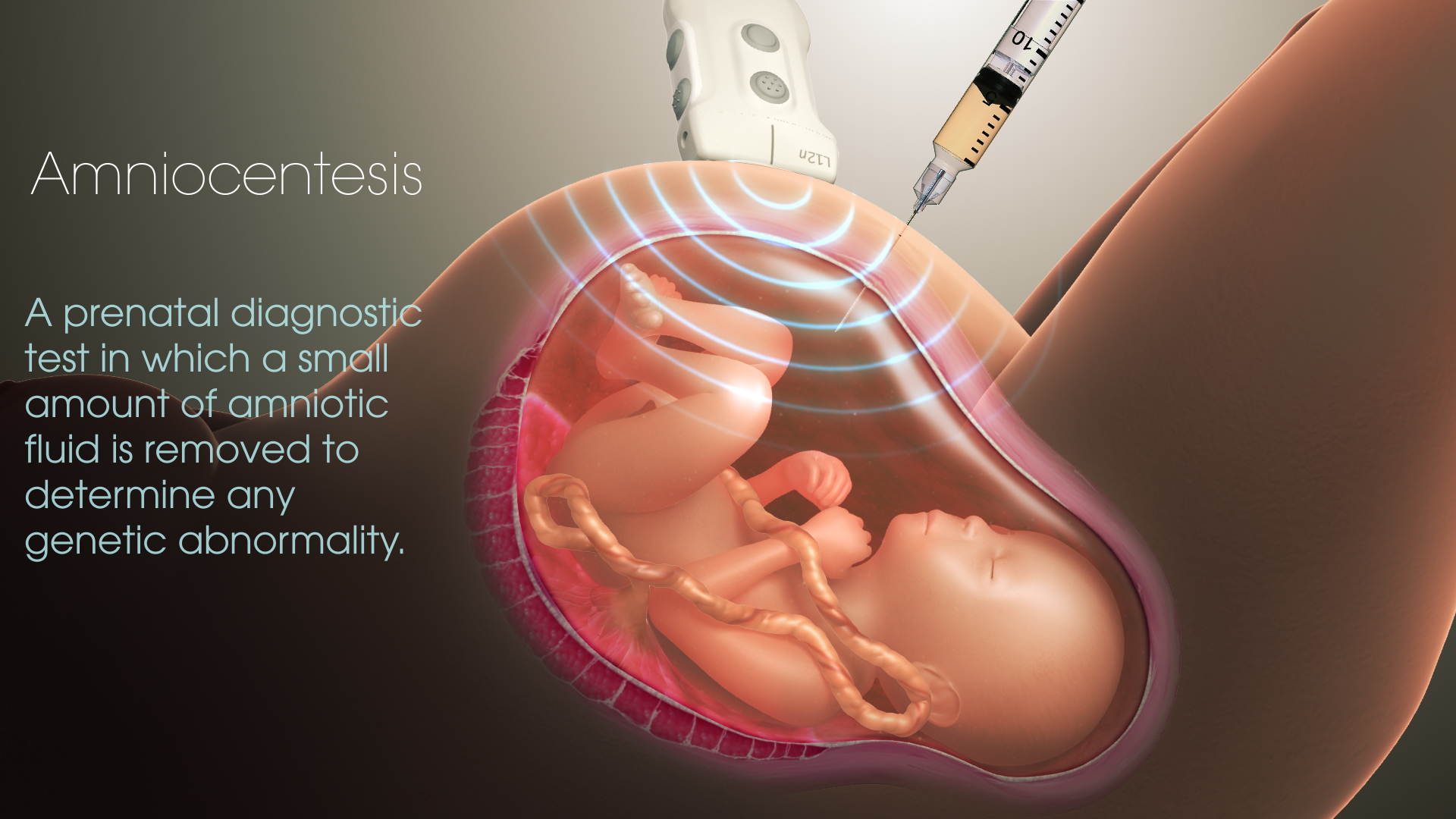 What Are The Risks Of Having An Amniocentesis