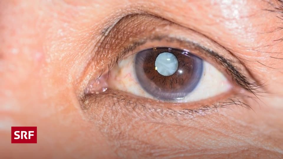 Teure Augen Operationen Aufgepasst Bei Der Operation Des Grauen Stars Wissen Srf