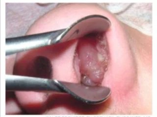 Kebiasaan Buruk Bernafas Melalui Mulut (Mouth Breathing) | Tooth Signature  Jakarta