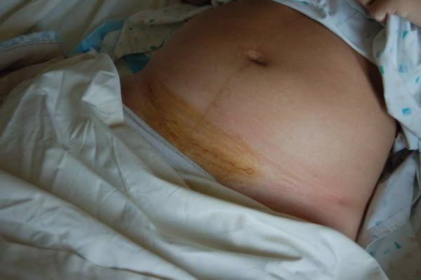 Ini Tanda Jahitan Caesar Anda Sudah Sembuh | YesDok